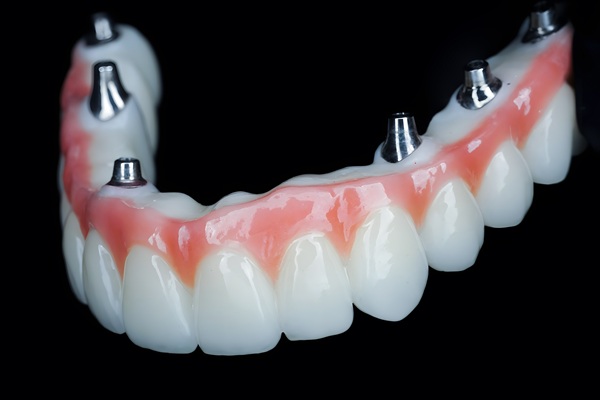 Factors To Consider Before Getting All On   Implants