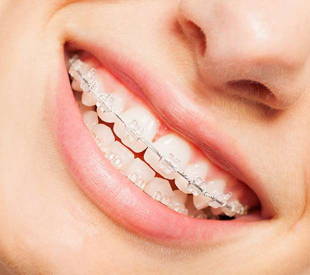 Port Saint Lucie Clear Braces