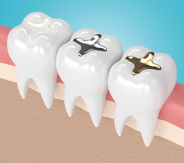 Port Saint Lucie Composite Fillings