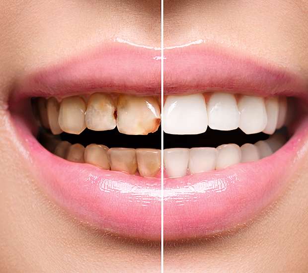 Port Saint Lucie Dental Implant Restoration