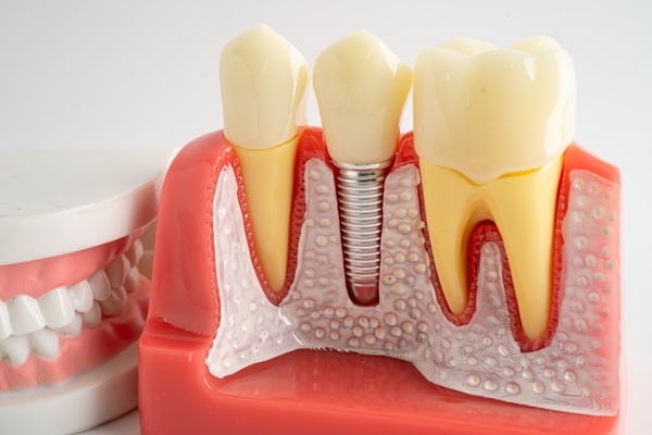 Can You Get Dental Implants For More Than One Missing Tooth?