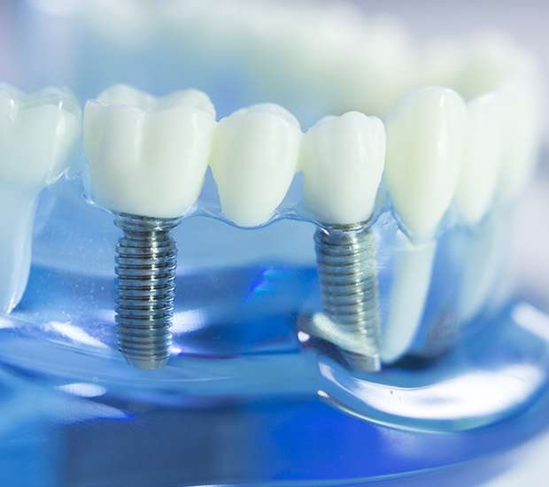 Port Saint Lucie Dental Implants