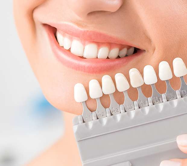 Port Saint Lucie Dental Veneers and Dental Laminates