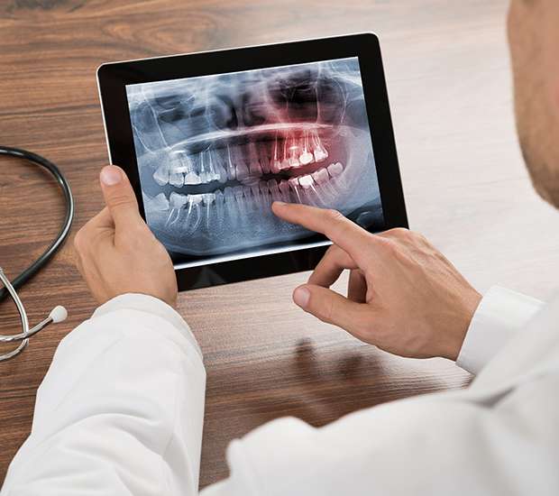 Port Saint Lucie Types of Dental Root Fractures