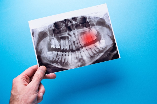 Reasons Dentists May Recommend To Have Wisdom Teeth Removed