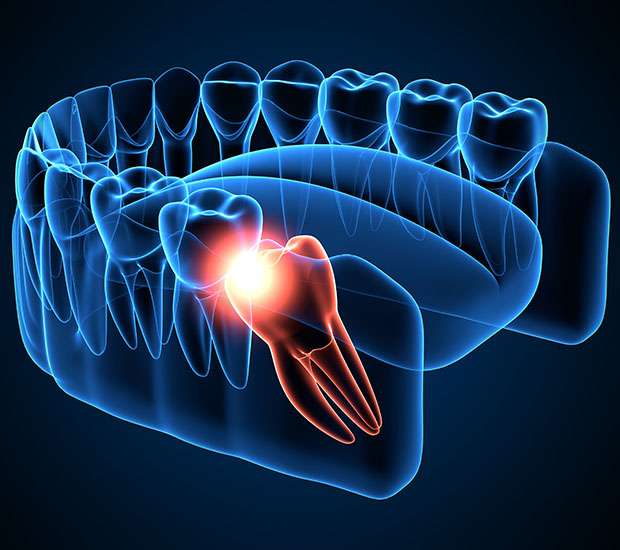 Port Saint Lucie Wisdom Teeth Extraction